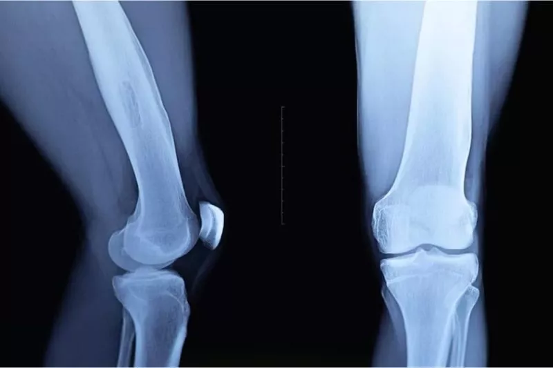x-ray