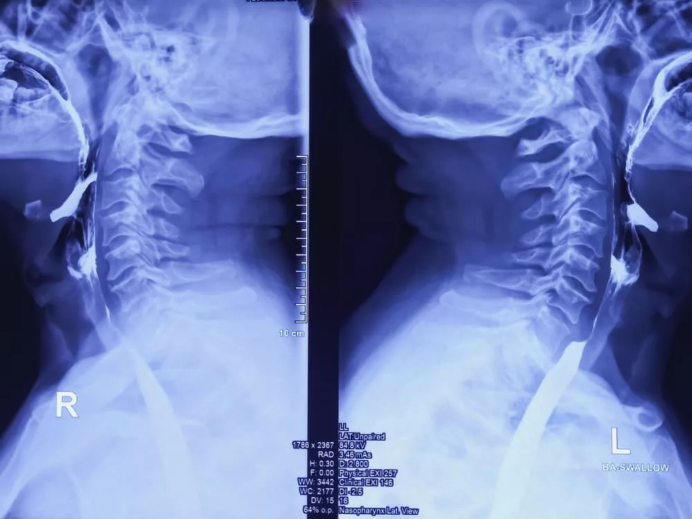 X-Ray
