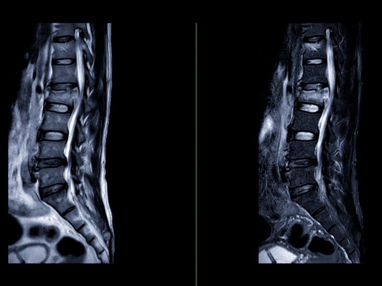 Sagittal MRI scans of the lower spine showing lumbar vertebrae, spinal canal, and intervertebral discs.