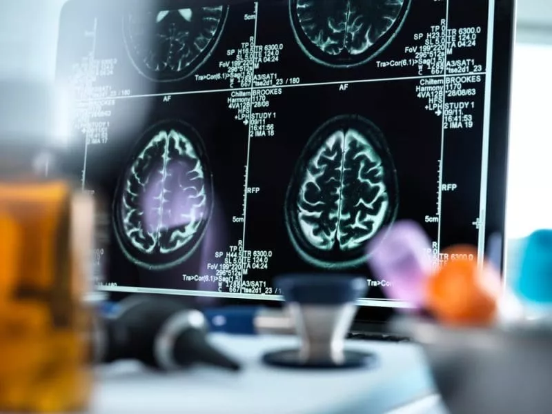 Cerebrovascular Disease: Signs, Risks, and Prevention