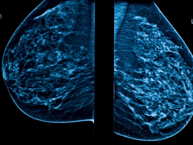 Mammogram images showing right and left breast views side by side in a diagnostic imaging display.