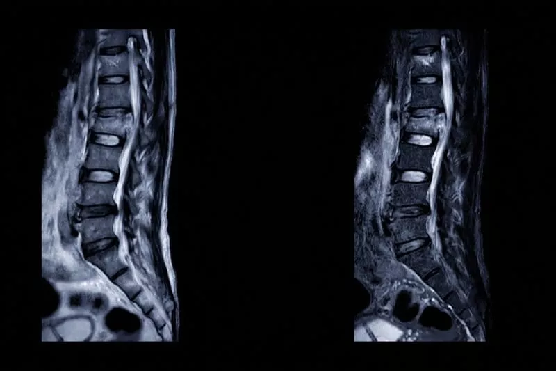 Side-by-side MRI scans of the lower spine showing vertebrae and spinal discs against a black background.