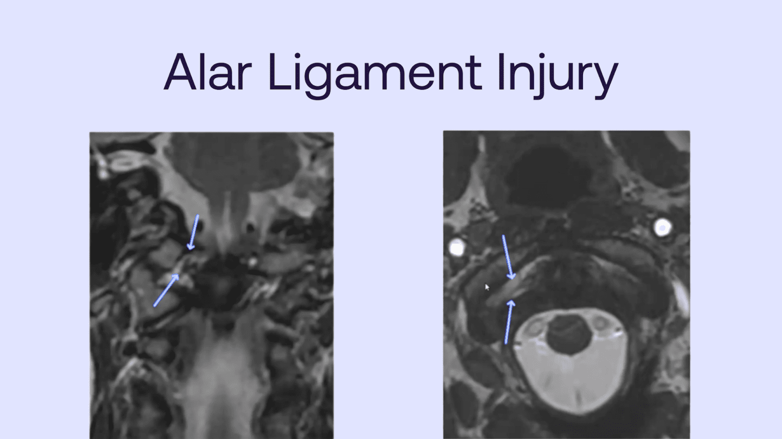 MRI showing alar ligament injury with highlighted areas in upper cervical spine