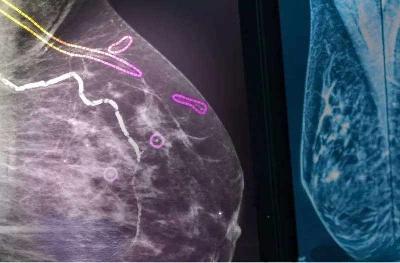 How AI is helping radiologists see more