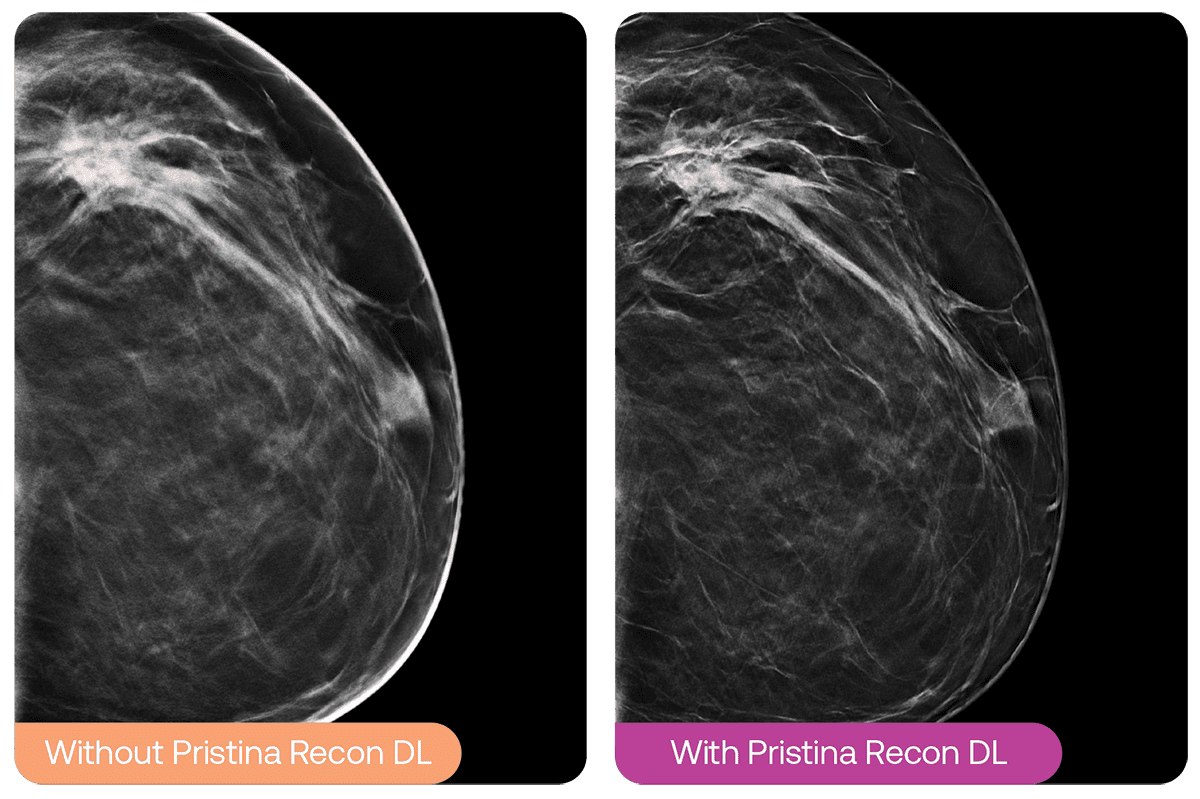 Side-by-side mammogram images comparing image quality without and with Pristina Recon DL. The image on the right shows sharper, more clearly defined breast tissue details than the image on the left.